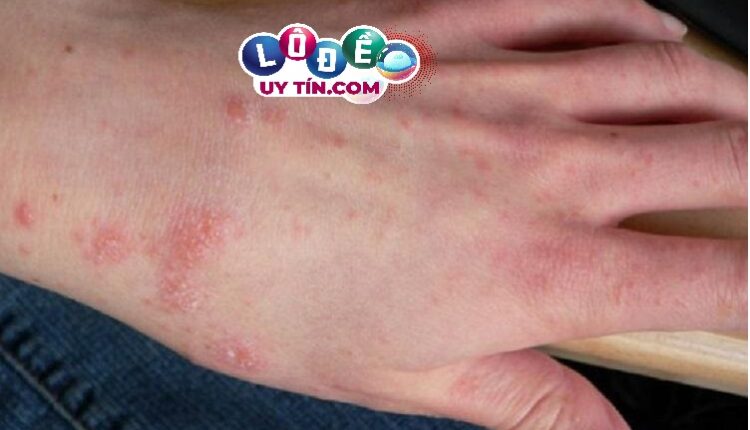 Nằm mơ thấy bị ghẻ lở là điềm gì? Đánh số nào 1 
