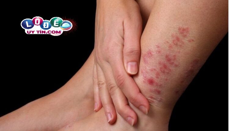 Nằm mơ thấy bị ghẻ lở là điềm gì? Đánh số nào?