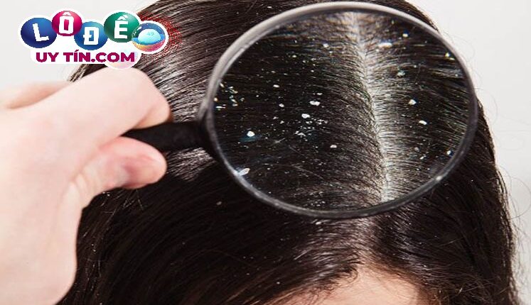 Giải mã giấc mơ thấy đầu có chấy - Số nào may mắn
